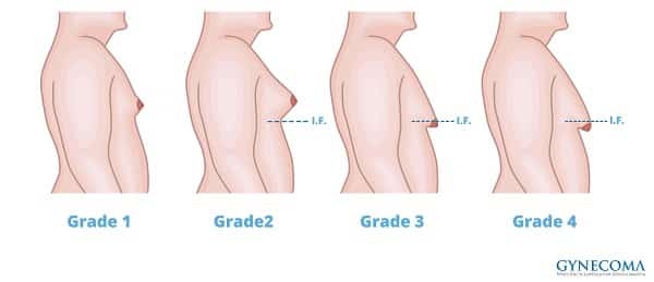 grades of gynecomastia surgery