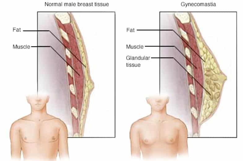 normal breast vs gynecomastia diagram