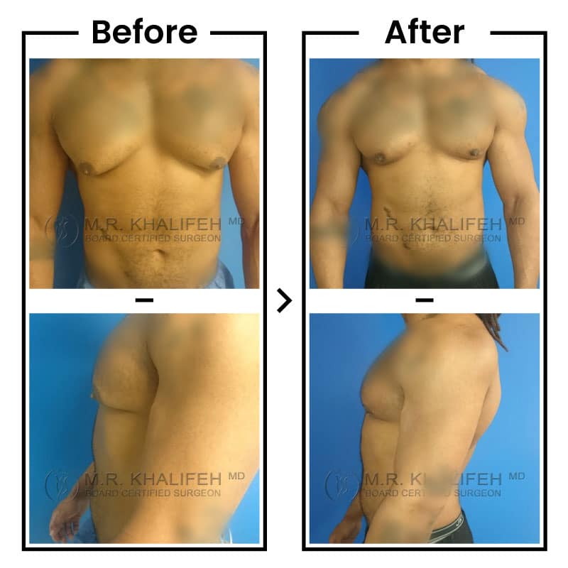 Gynecomastia Before and After