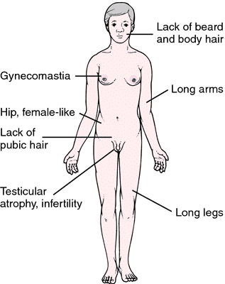 Kleinfelter and gyneomastia