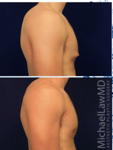 Gynecomastia Correction