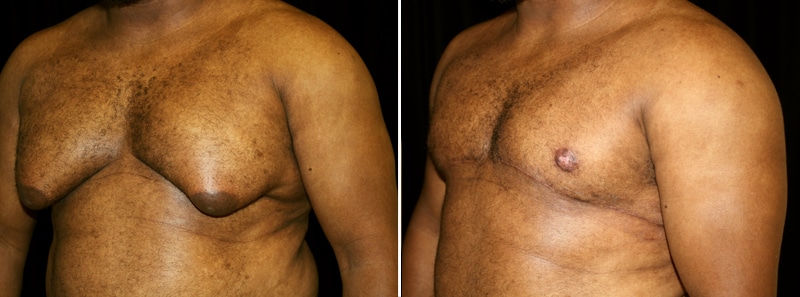 gynecomastia before and after, free nipple double incision mastectomy