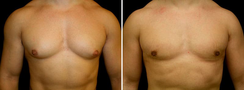 gynecomastia before and after photo