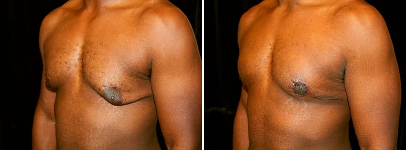 Gynecomastia before and after estrogen