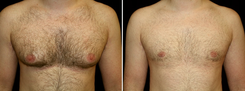 gynecomastia before and after