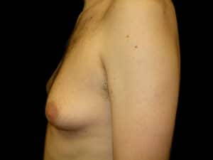 man boobs before gynecomastia surgery