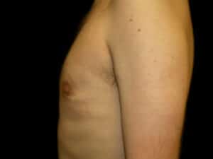 man boobs after gynecomastia surgery