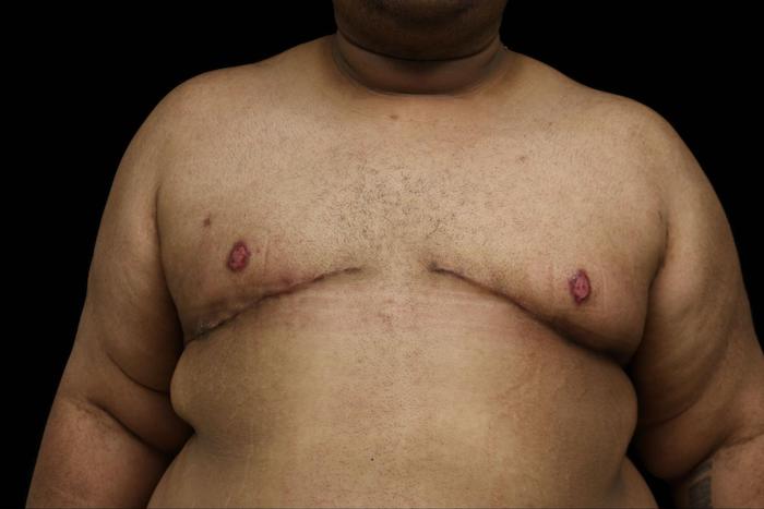 after Double incision Mastectomy surgery