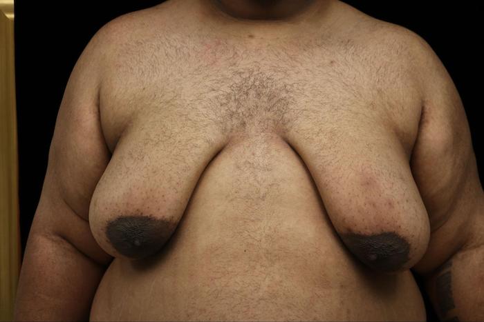 before images of Double incision Mastectomy surgery