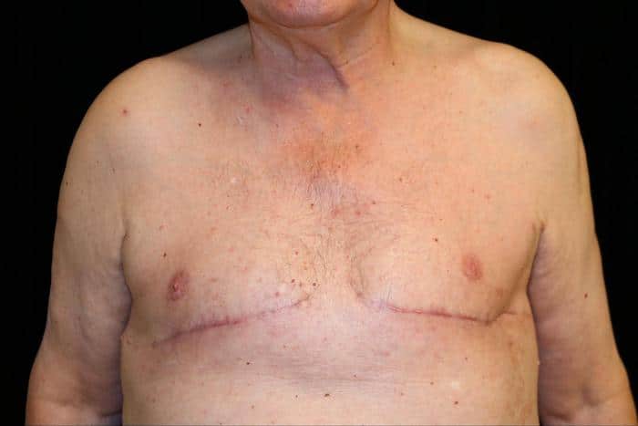 double incision mastectomy surgery after