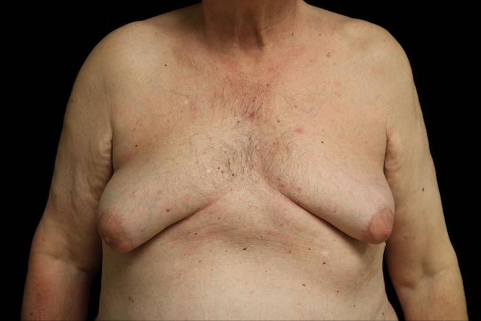 Double Incision Mastectomy Surgery Before