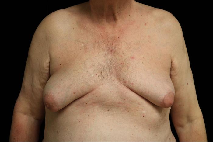 double incision mastectomy surgery before