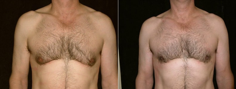 Gynecomastia Patient 13 Before & After