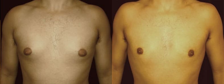 Gynecomastia Patient 14 Before & After