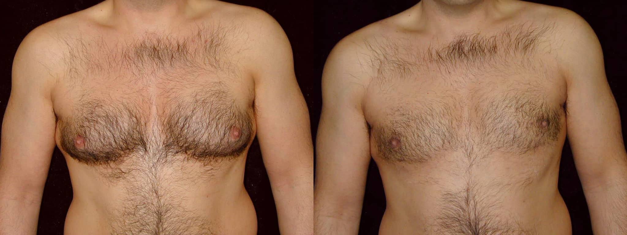 Gynecomastia Patient 4 Before & After