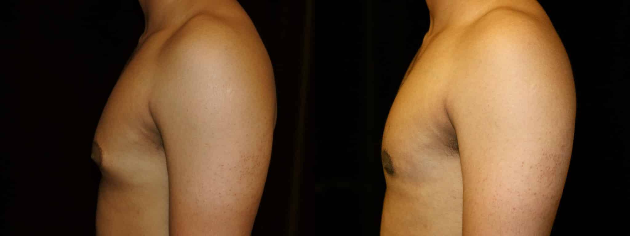 Gynecomastia Patient 15 Before & After Details