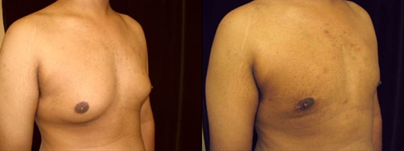 Gynecomastia Patient 1 Before & After Details