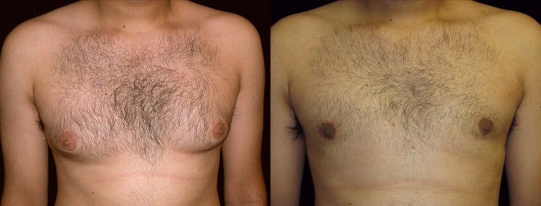 Gynecomastia Patient 6 Before & After