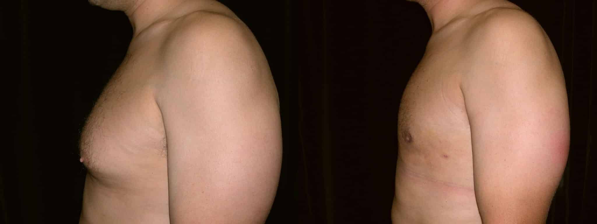 Gynecomastia Patient 9 Before & After Details