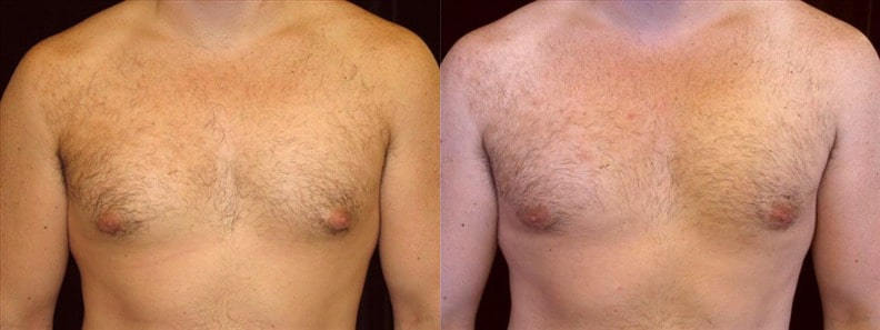 Gynecomastia Patient 5 Before & After