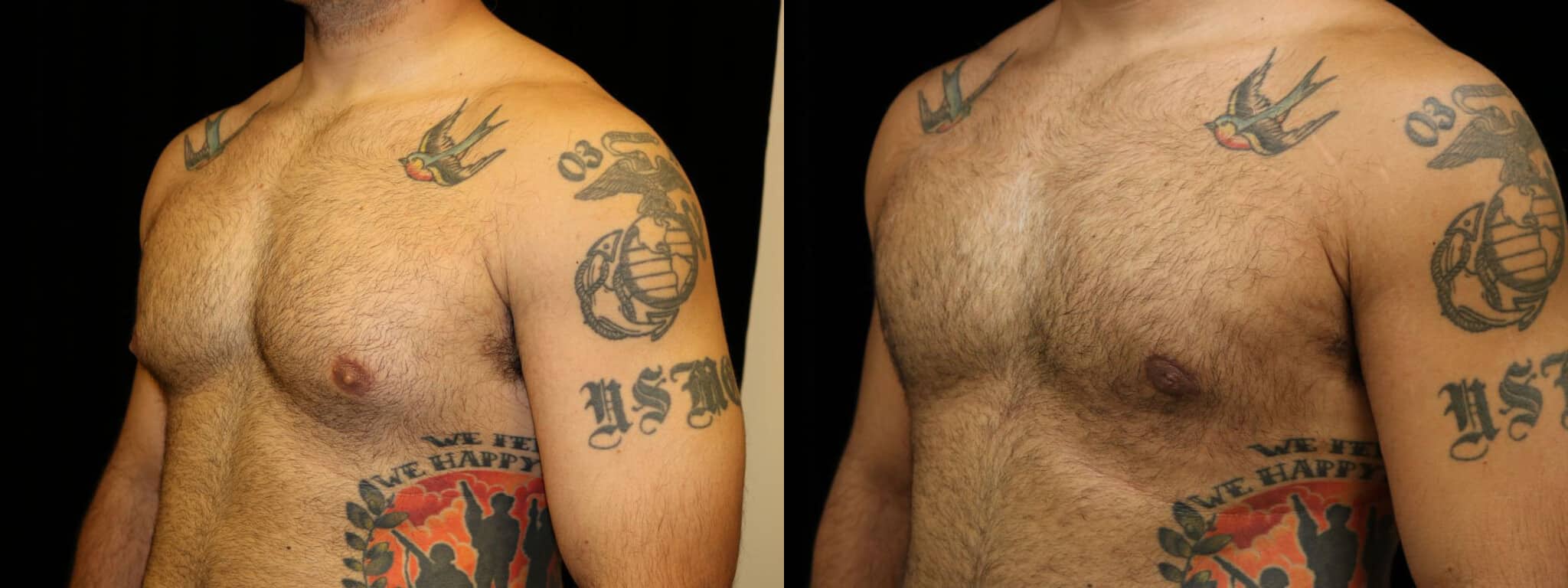 Gynecomastia Patient 6 Before & After Details