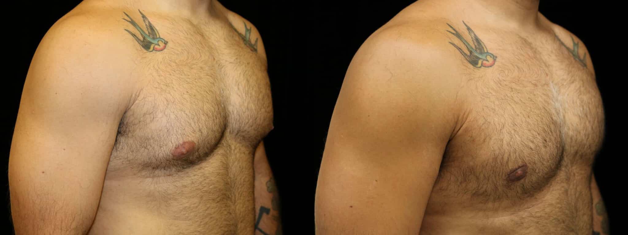 Gynecomastia Patient 6 Before & After Details