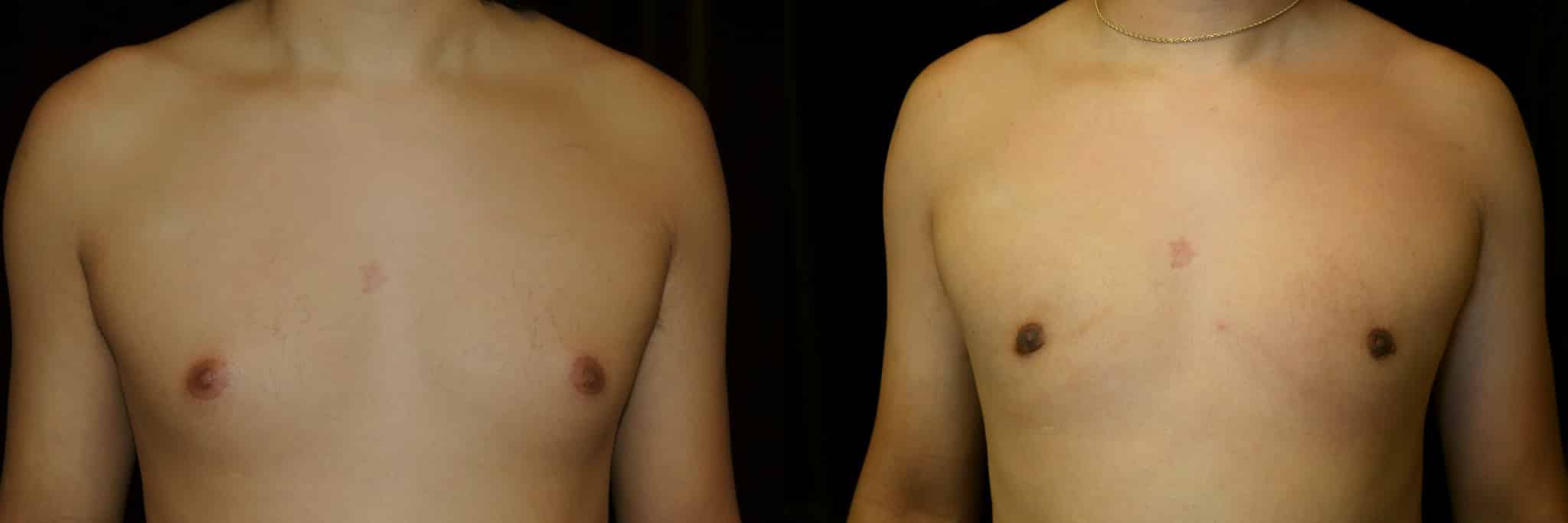 Gynecomastia Patient 7 Before & After