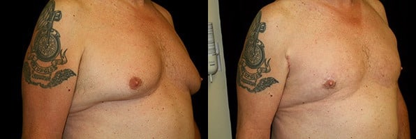 Gynecomastia Patient 21 Before & After Details