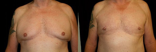 Gynecomastia Patient 21 Before & After