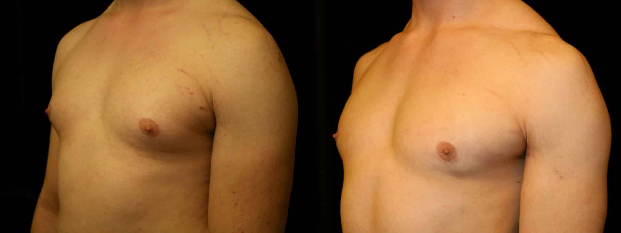 Gynecomastia Patient 15 Before & After Details