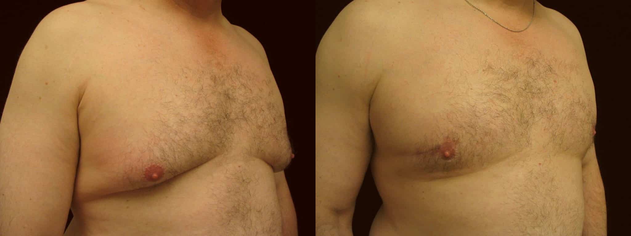 Gynecomastia Patient 4 Before & After Details