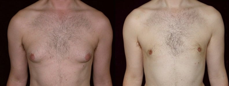 Gynecomastia Patient 1 Before & After