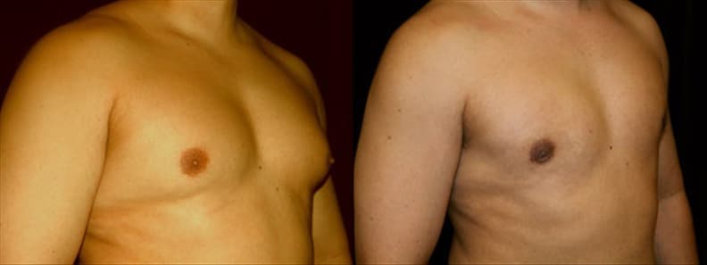 Gynecomastia Patient 10 Before & After Details