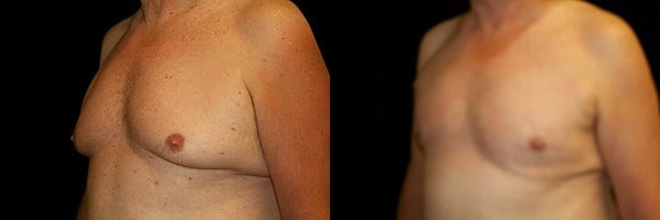 Gynecomastia Patient 21 Before & After Details