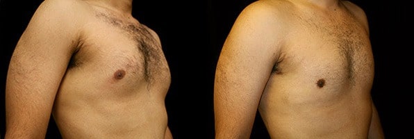 Gynecomastia Patient 11 Before & After Details