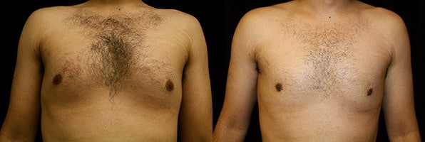 Gynecomastia Patient 11 Before & After