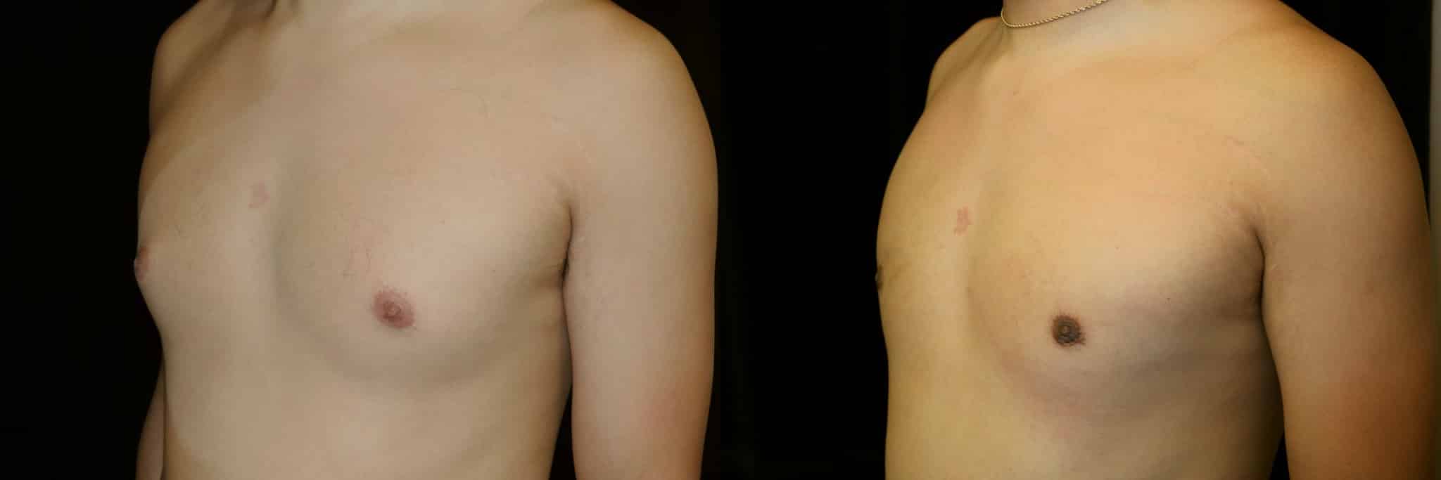 Gynecomastia Patient 7 Before & After Details