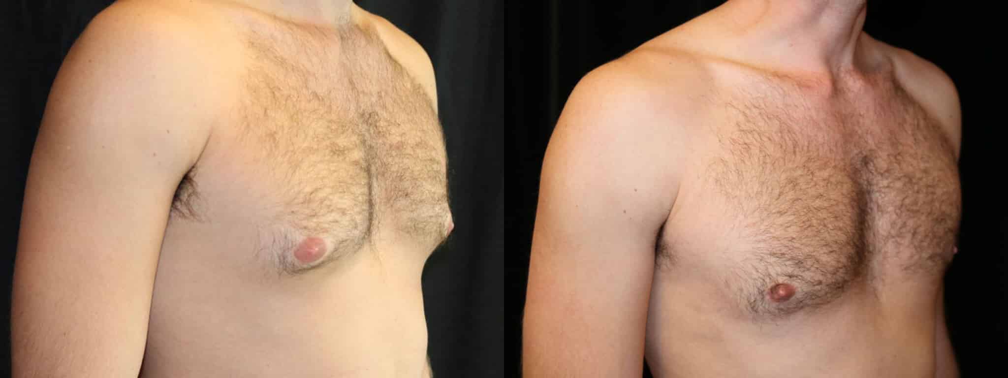 Gynecomastia Patient 7 Before & After Details