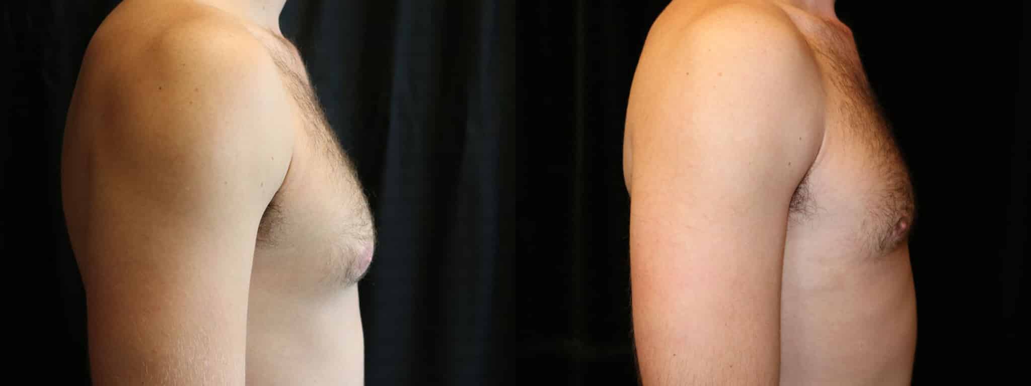 Gynecomastia Patient 7 Before & After Details