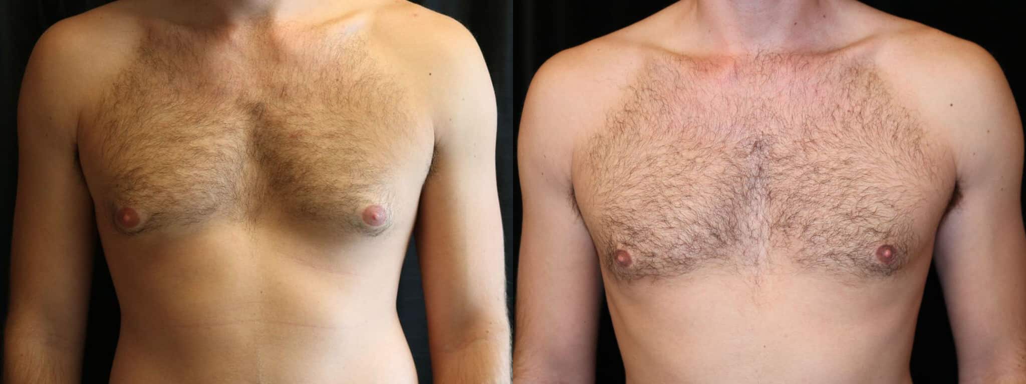 Gynecomastia Patient 7 Before & After