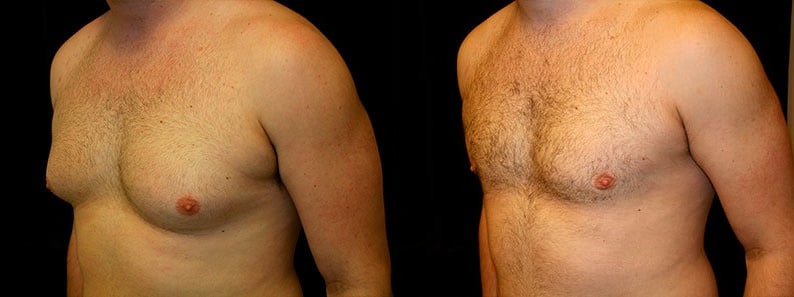 Gynecomastia Patient 6 Before & After Details