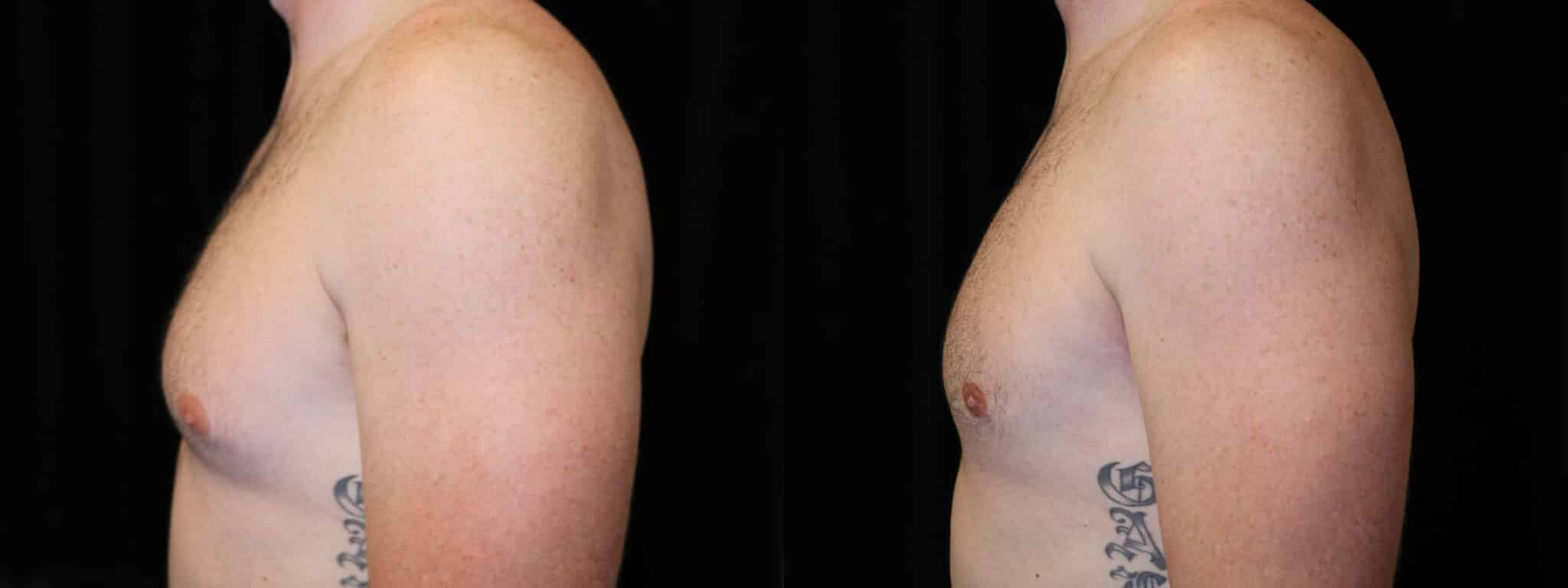 Gynecomastia Patient 19 Before & After Details