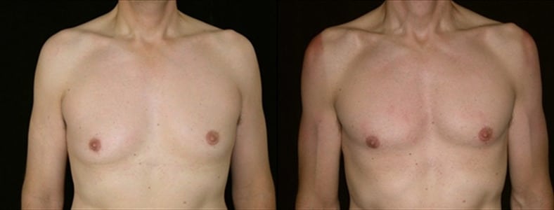 Gynecomastia Patient 18 Before & After