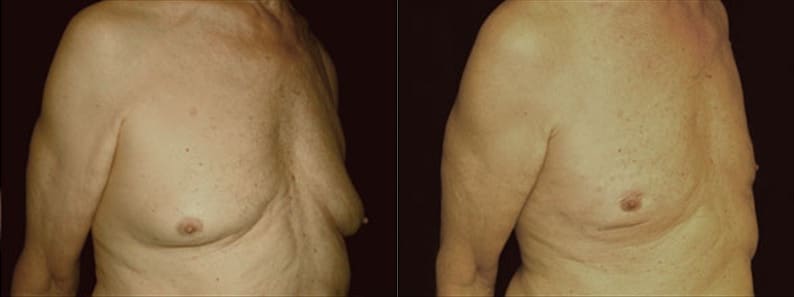 Gynecomastia Patient 15 Before & After Details