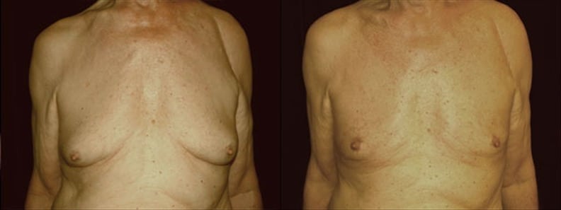 Gynecomastia Patient 15 Before & After