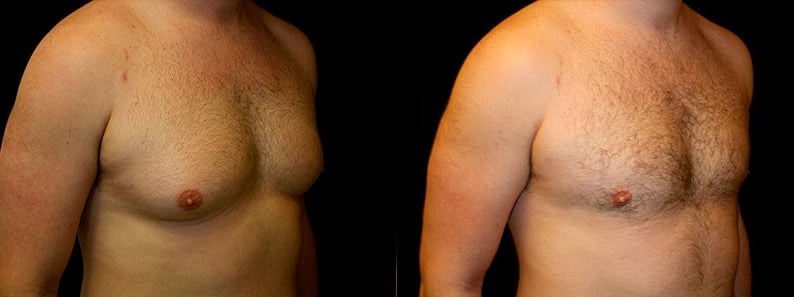 Gynecomastia Patient 6 Before & After Details