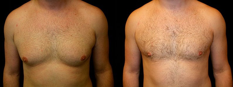 Gynecomastia Patient 6 Before & After