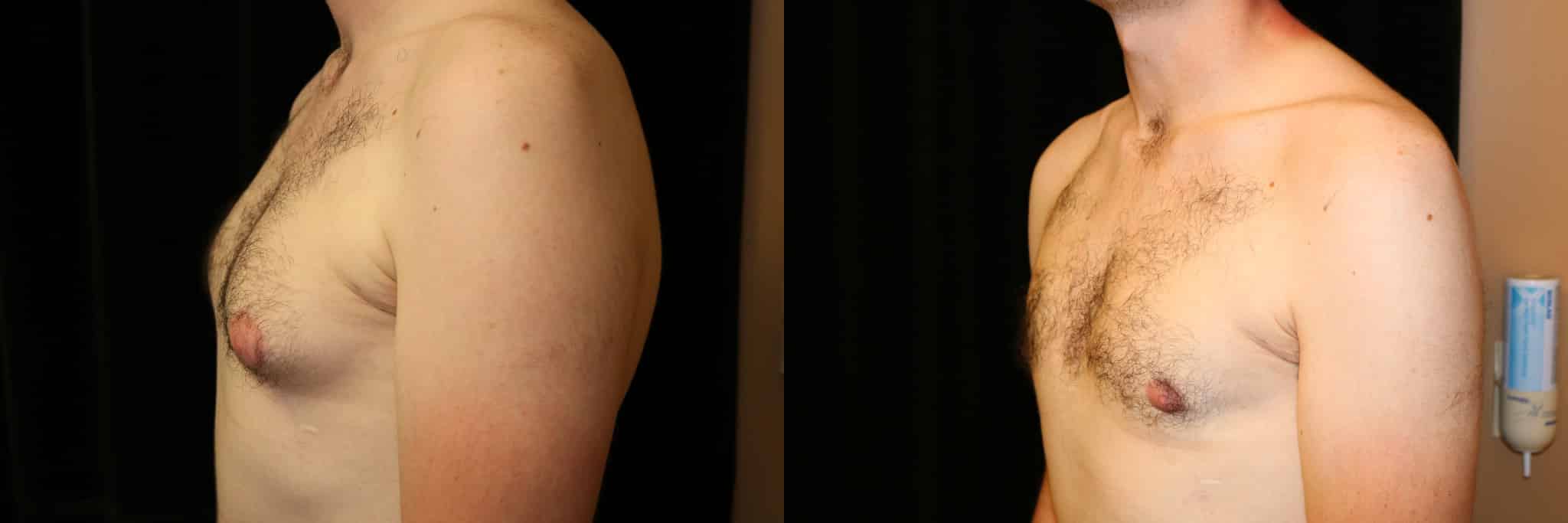 Gynecomastia Patient 21 Before & After Details