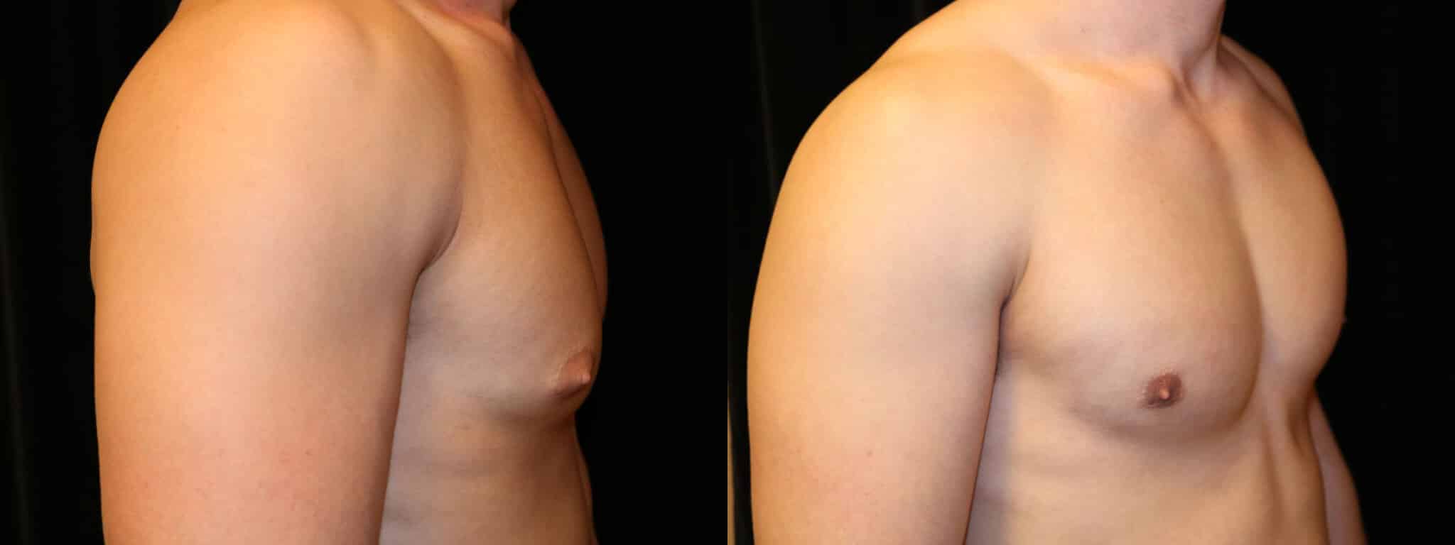 Gynecomastia Patient 14 Before & After Details