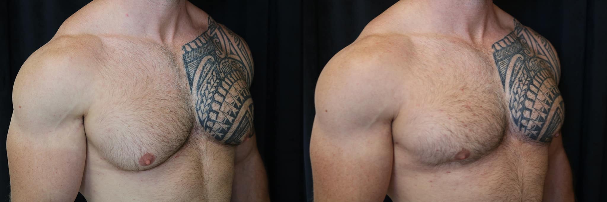 Gynecomastia Patient 9 Before & After Details